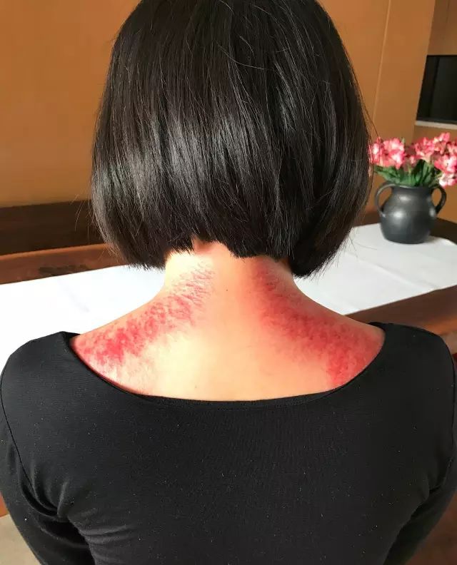 肩颈不舒服的朋友可以哪里痛就刮