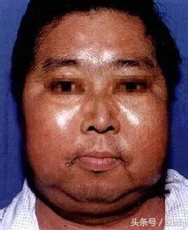简单的分析可以看出这些征象背后的疾病真容 酒糟鼻,满月脸 酒糟鼻是