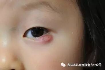 莫把霰粒肿当针眼 自由微信 Freewechat