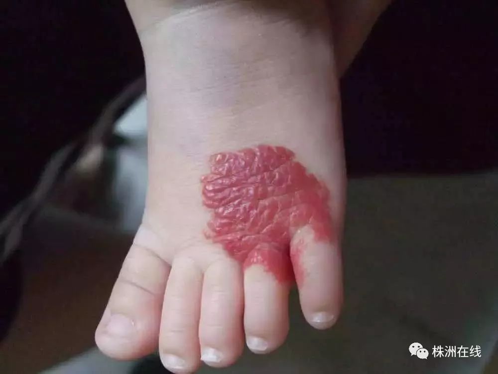 3,毛细血管瘤