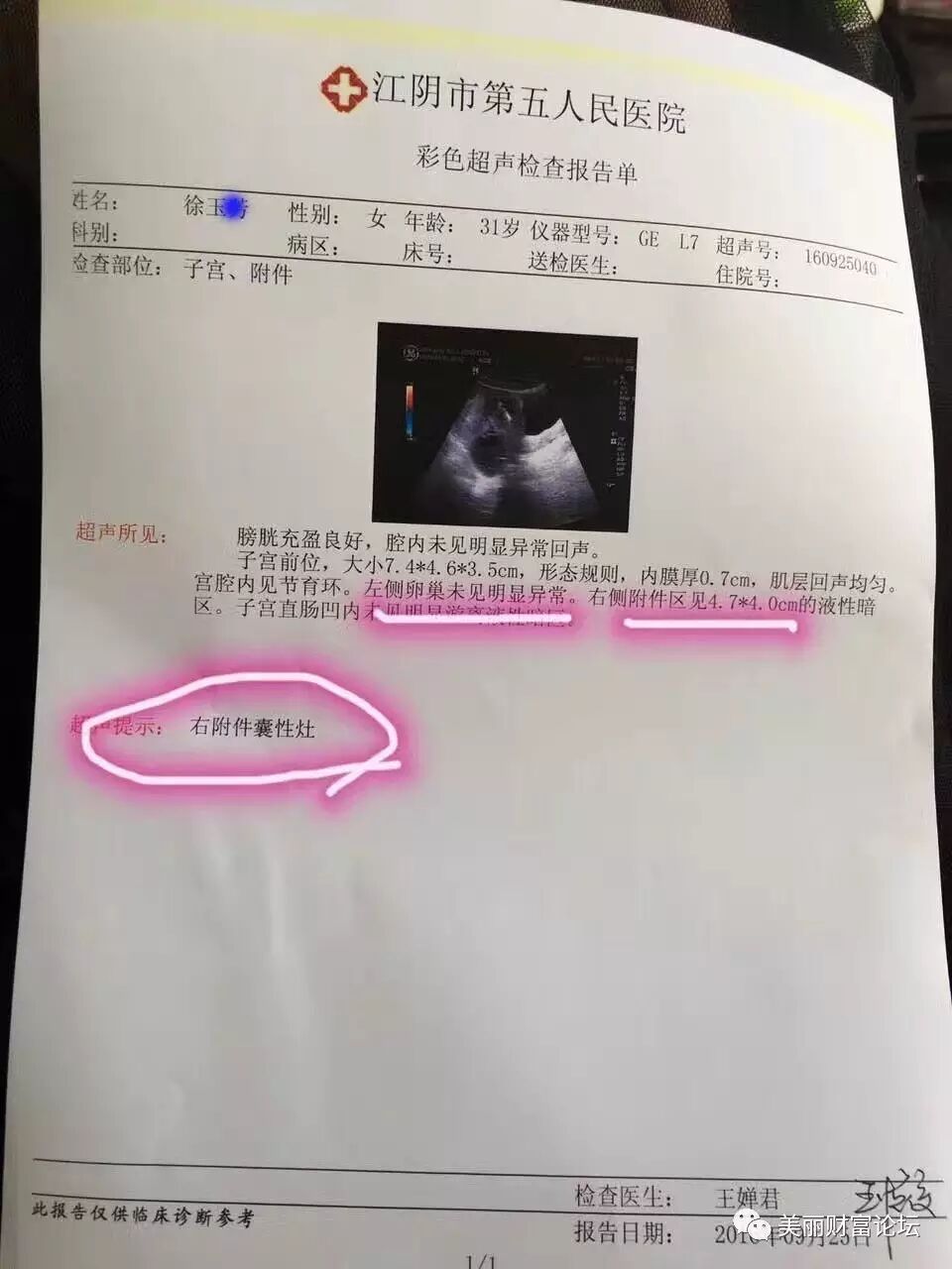 案例四:宫颈囊肿案例