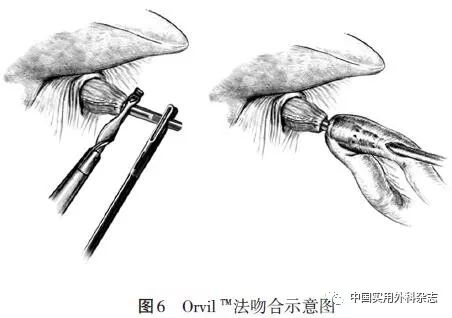 这种方式与以往圆形吻合器吻合最大之区别在于,是经口由上而下自食管