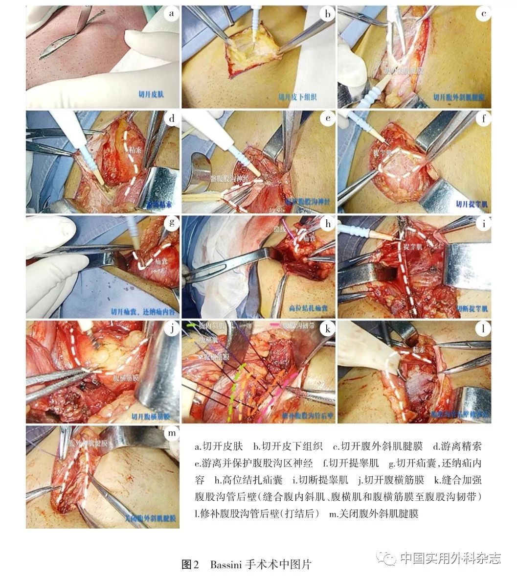 2.2 禁忌证 (1)股疝.(2)复发疝.(3)双侧巨大疝.(4)bmi></p></a>20.