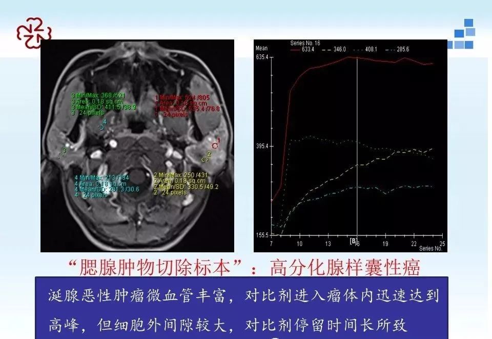腮腺腺淋巴瘤的影像学表现