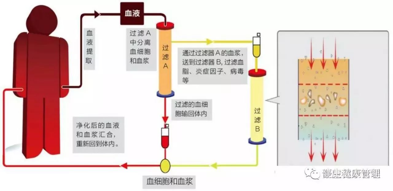 深层血液净化作用原理 在体外循环回路中分别连接血浆分离器(一级滤过