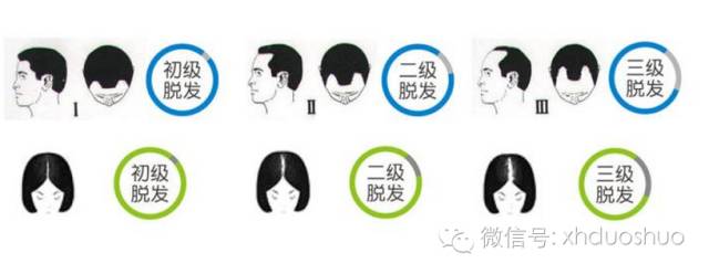 如何治疗脂溢性脱发？