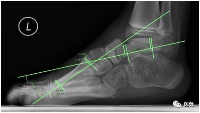 足部骨骼图_足部骨骼构造_人体骨骼足部