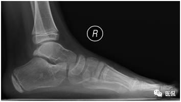 足部骨骼构造_足部骨骼图_人体骨骼足部