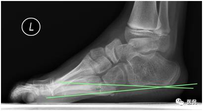 足部骨骼图_人体骨骼足部_足部骨骼构造