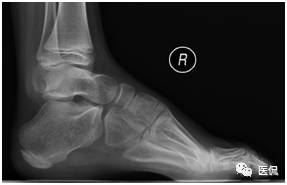 足部骨骼图_人体骨骼足部_足部骨骼构造