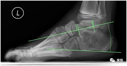 足部骨骼图_足部骨骼构造_人体骨骼足部