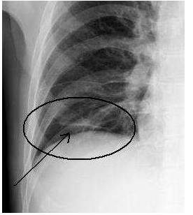 ↓ 结肠癌术后,左下肺盘状肺不张,右侧膈下游离气体