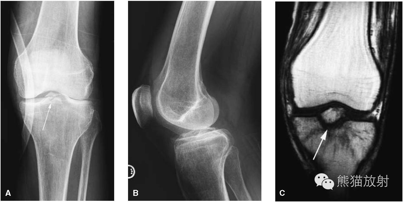 急诊 膝关节 胫腓骨 临床影像示例 自由微信 Freewechat