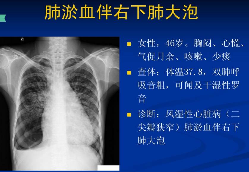 【x线诊断要点】肺水肿,肺栓塞和肺梗死(结合ct)