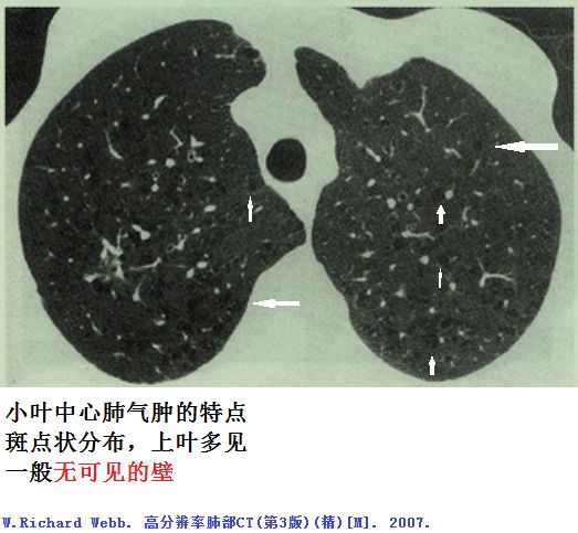 肺大泡肺气肿肺气囊囊肿空洞ct如何鉴别