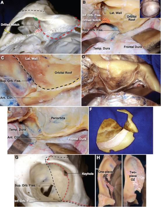 这一步从眶上切迹外侧的眶顶开始切开骨质,接着转到眶上裂的外上界
