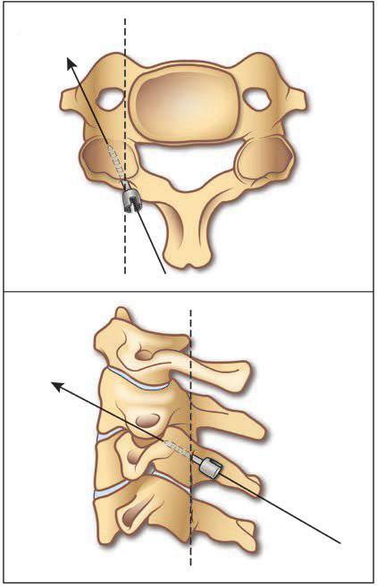 颈椎小关节脱位--atlas of emergency neurosurgery第九期