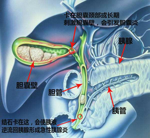 体检发现胆结石该怎么办