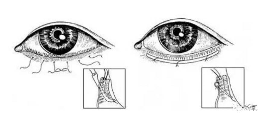 为了改善这种问题,医生们用手术方式,将下眼睑对应的位置拉下来,使