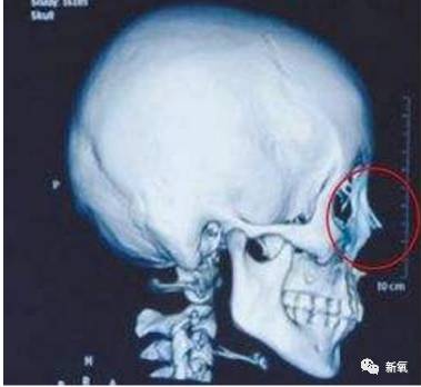 正常人的中面部骨骼是这样的.