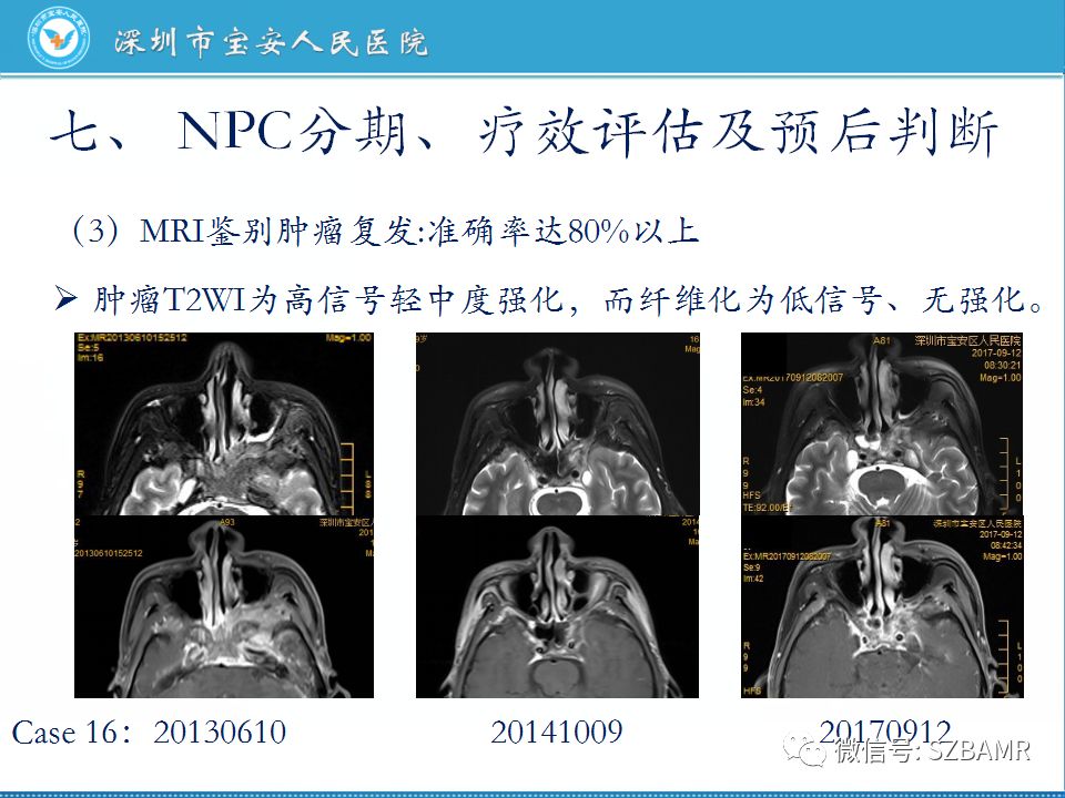 学术交流 正文  鼻咽癌影像鉴别诊断与放疗评估