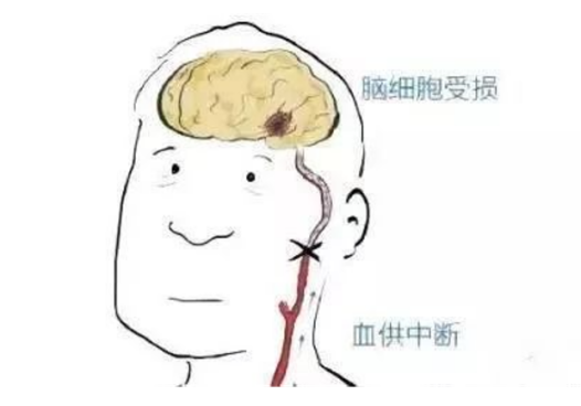 脑卒中产生的原理