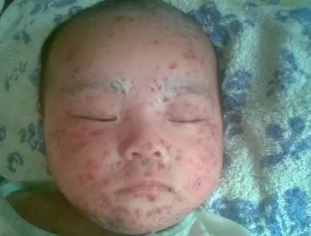 湿疹,急疹,痱子,荨麻疹,水痘,婴儿痤疮,过敏等婴儿疾病的区别!