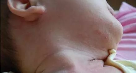 湿疹,急疹,痱子,荨麻疹,水痘,婴儿痤疮,过敏等婴儿疾病的区别!