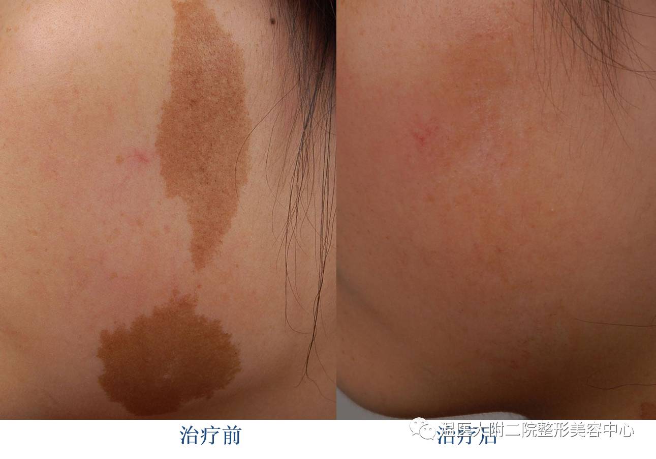 二氧化碳(co2)激光治疗是什么瘢痕的“克星”——超脉冲co2点阵激光_https://www.jmylbn.com_新闻资讯_第13张