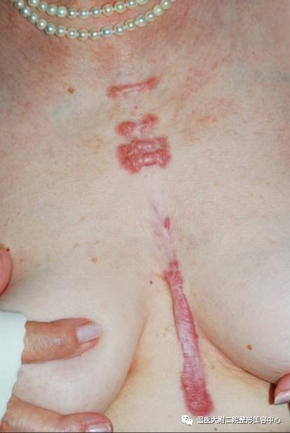 二氧化碳(co2)激光治疗是什么瘢痕的“克星”——超脉冲co2点阵激光_https://www.jmylbn.com_新闻资讯_第4张