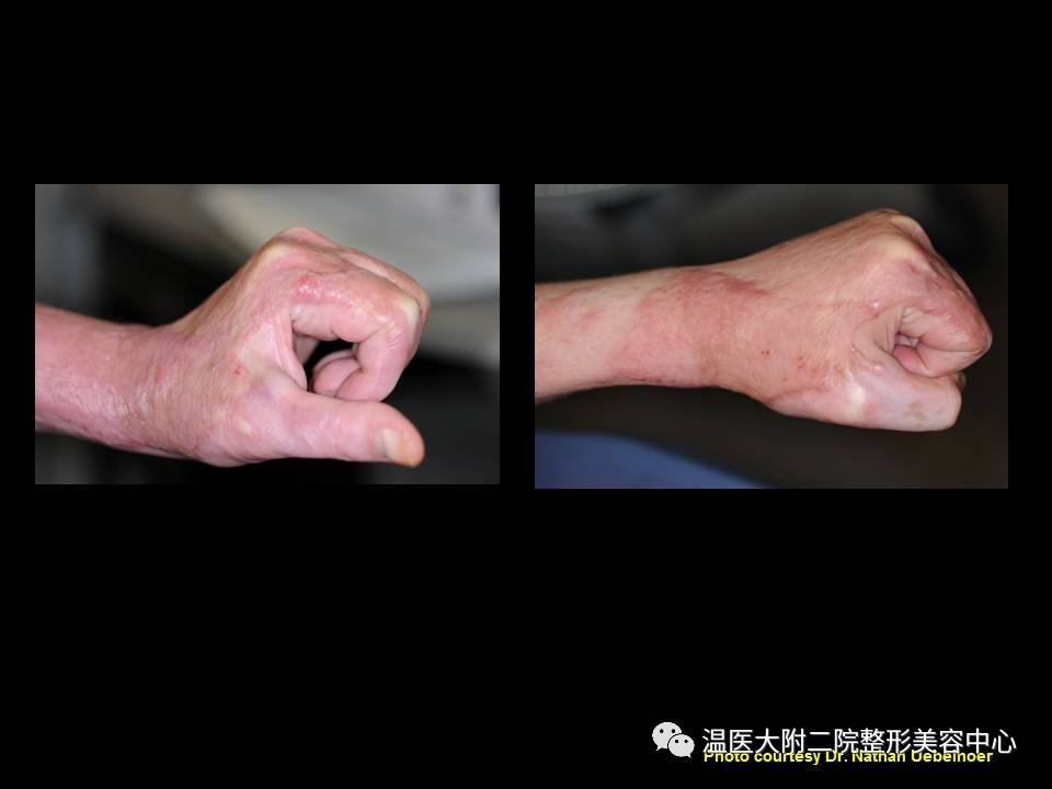 二氧化碳(co2)激光治疗是什么瘢痕的“克星”——超脉冲co2点阵激光_https://www.jmylbn.com_新闻资讯_第10张