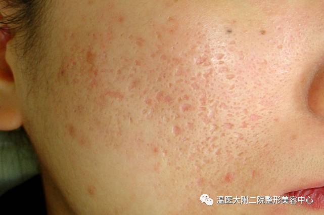 二氧化碳(co2)激光治疗是什么瘢痕的“克星”——超脉冲co2点阵激光_https://www.jmylbn.com_新闻资讯_第6张