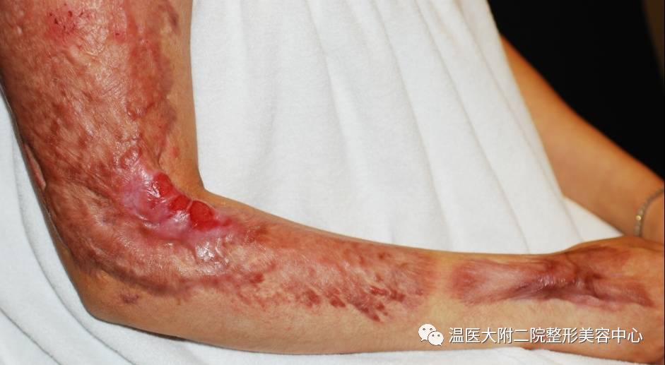 二氧化碳(co2)激光治疗是什么瘢痕的“克星”——超脉冲co2点阵激光_https://www.jmylbn.com_新闻资讯_第5张