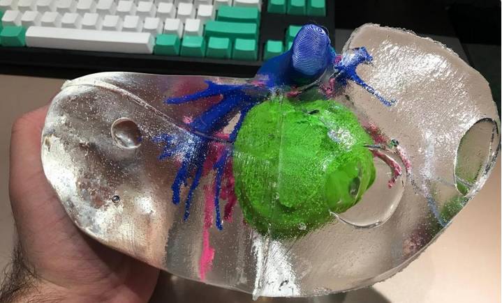 辅助肿瘤手术的3d打印肝脏模型普及有望,仅需不到 150 美元