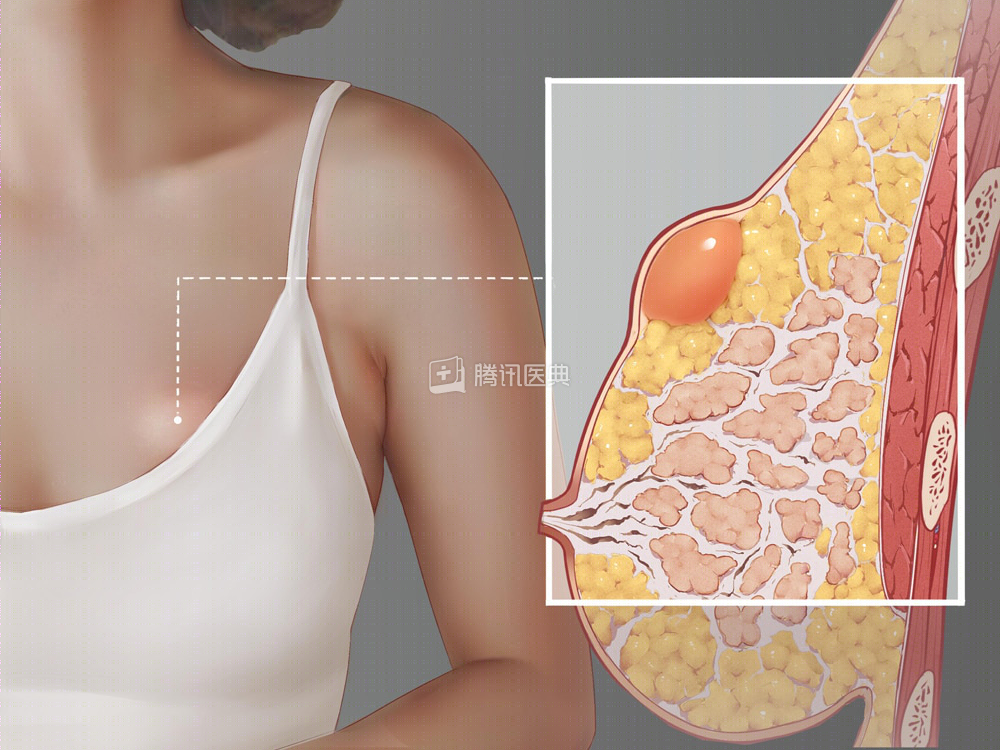 长在乳房里的这种瘤，对身体伤害并不大，一个办法就能去除