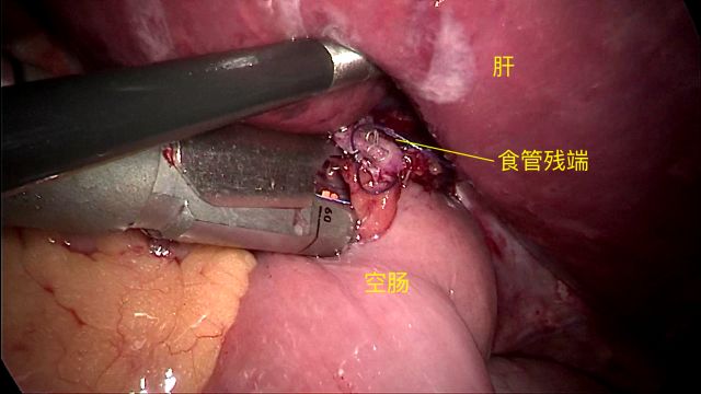 腹腔镜胃癌全胃切除术(稍有血腥,饭前慎看!)