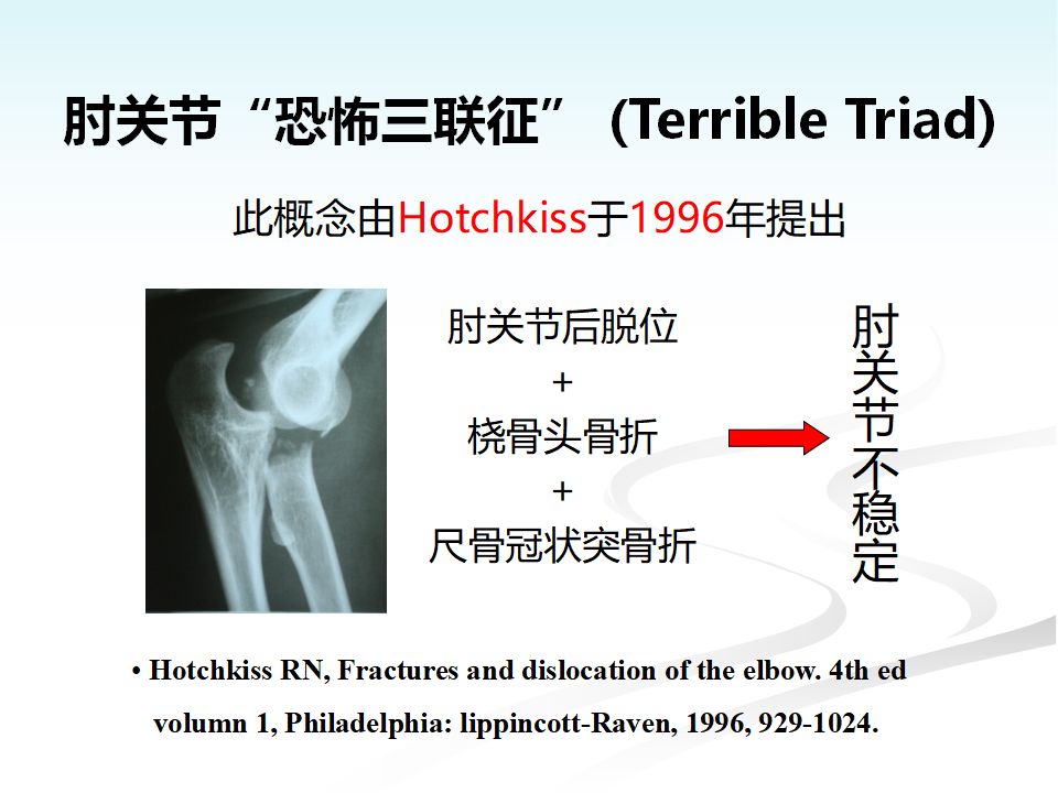 肘关节恐怖三联征的规范化治疗原则