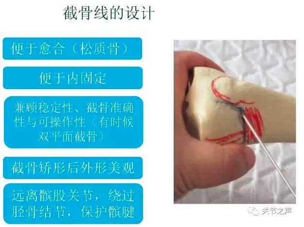 然后做上斜截骨(superior oblique osteotomy),绕过胫骨结节,做出一个