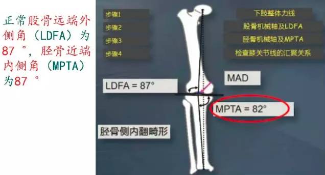 此病例首先确定下肢力线,可知道为内翻畸形,再确定内翻来自哪里.