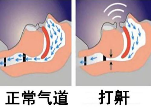 要弄明白为啥它能止鼾 得先搞清楚打呼噜的原因: 经常听家里的老人