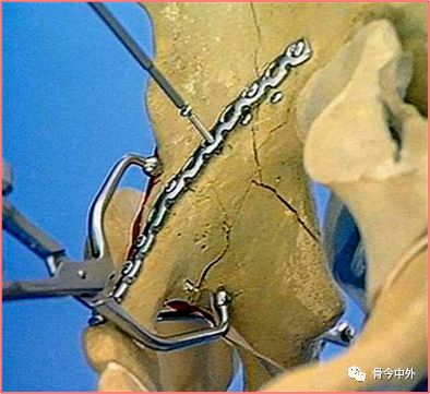 专题教程:骨盆髋臼骨折前方手术入路--stoppa及其改良