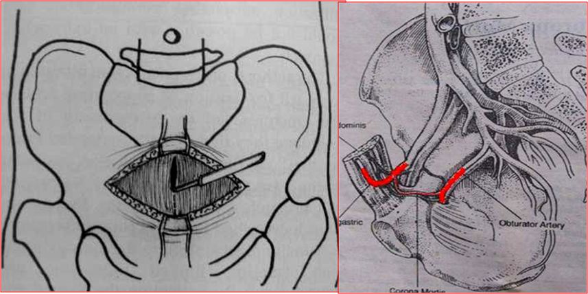 专题教程:骨盆髋臼骨折前方手术入路--stoppa及其改良