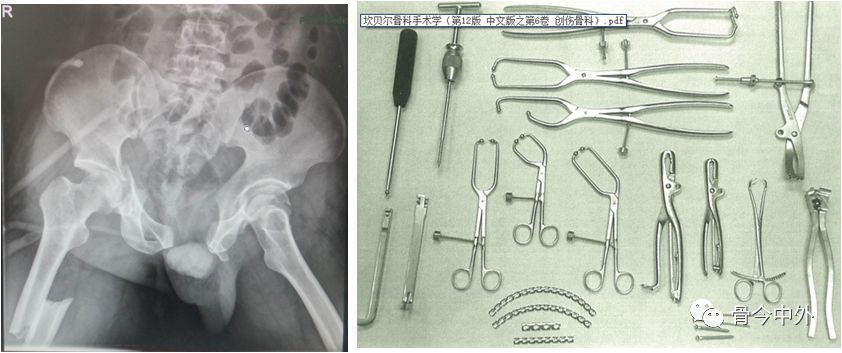 专题教程:骨盆髋臼骨折前方手术入路--stoppa及其改良