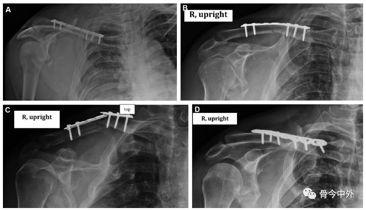综述教程:锁骨骨折治疗的六大关键问题(下)