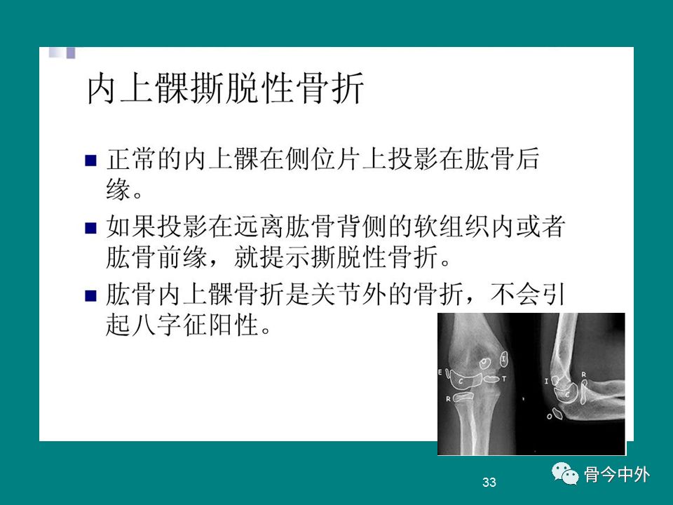 荐读:肘关节x线解剖及常见骨折诊断
