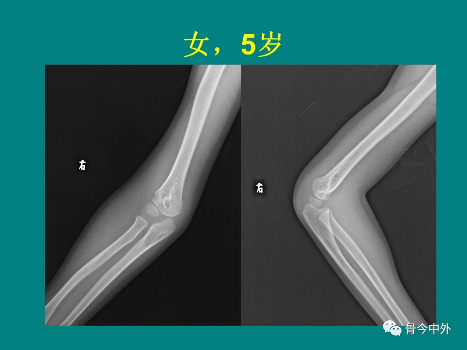 荐读:肘关节x线解剖及常见骨折诊断