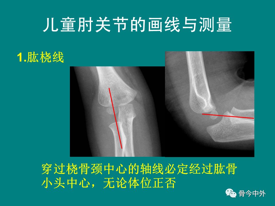 荐读:肘关节x线解剖及常见骨折诊断