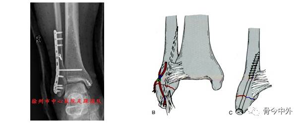 专题教程:三踝骨折的临床治疗
