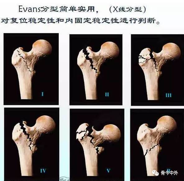 骨折 v型:大,小粗隆同时骨折,为iii型和iv型的合并 r型:逆转子间骨折