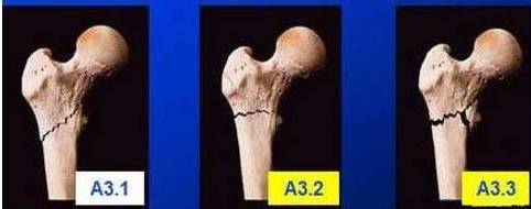 a1 转子间简单骨折